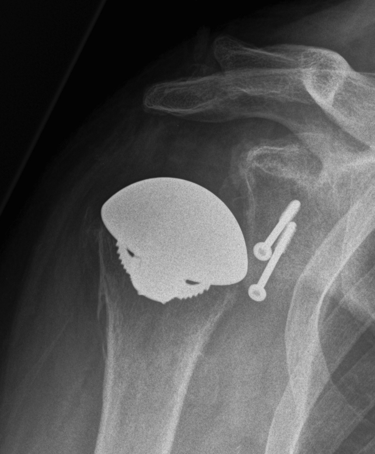 Humeral Head Autograft